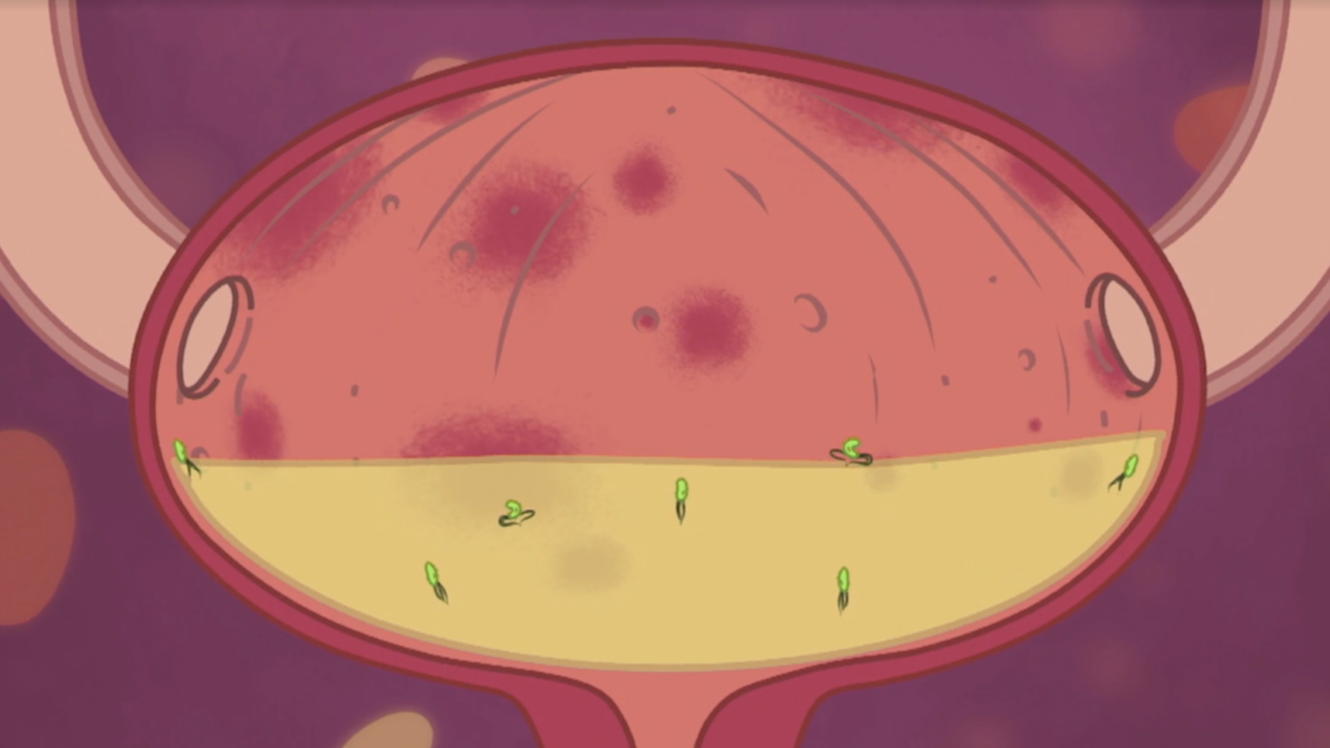 L'infection urinaire TiDoc’